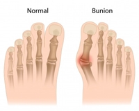 Understanding Bunions | Relief & Treatments