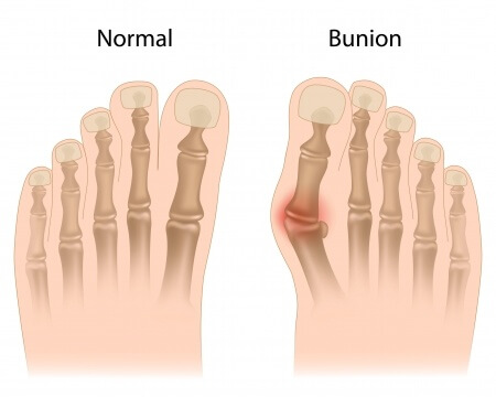 bunions on feet